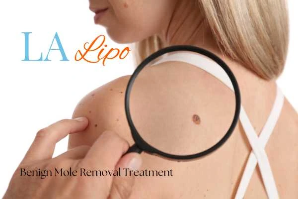 Woman having her inspection of blemish before mole removal Welford-on-Avon