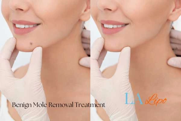 Before and after mole removal Welford-on-Avon treatment