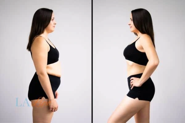 image of woman before and after results of LA-EMS Body Sculpting Welford-on-Avon to help treat Diastasis recti