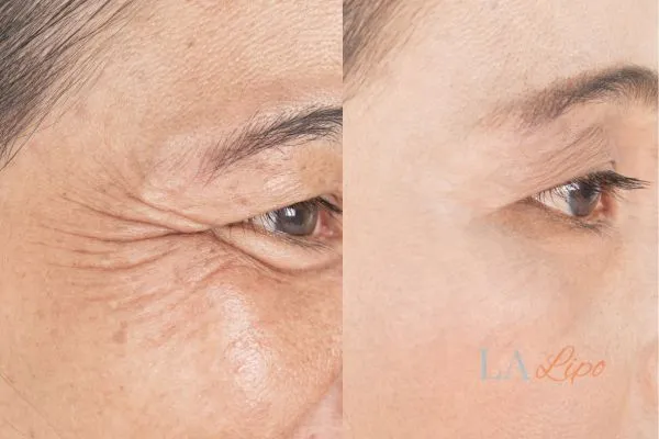 Before and after results of woman - HI-fu wrinkles reduction treatment Welford-on-Avon