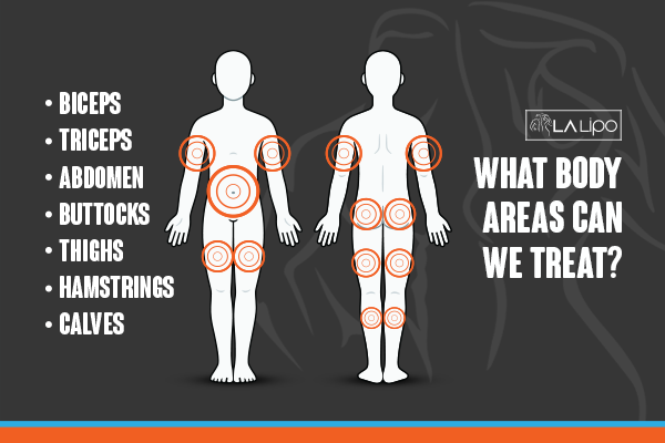Diagram to show areas you can have LA-EMS Body Sculpting Treatment Welford-on-Avon